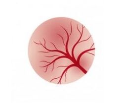 Inflammation of the bladder mucosa and treatment with femixal capsules